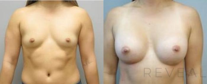 Before & After Breast Augmentation Case 490 View #1 View in San Jose, CA