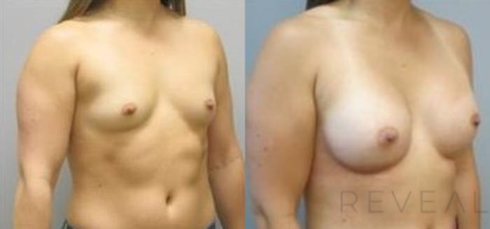 Before & After Breast Augmentation Case 490 View #2 View in San Jose, CA