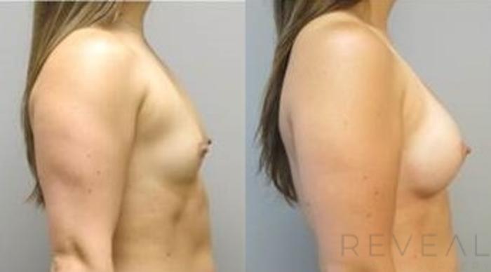 Before & After Breast Augmentation Case 490 View #3 View in San Jose, CA
