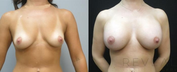 Before & After Breast Augmentation Case 491 View #1 View in San Jose, CA