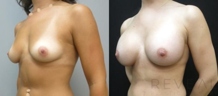 Before & After Breast Augmentation Case 491 View #2 View in San Jose, CA
