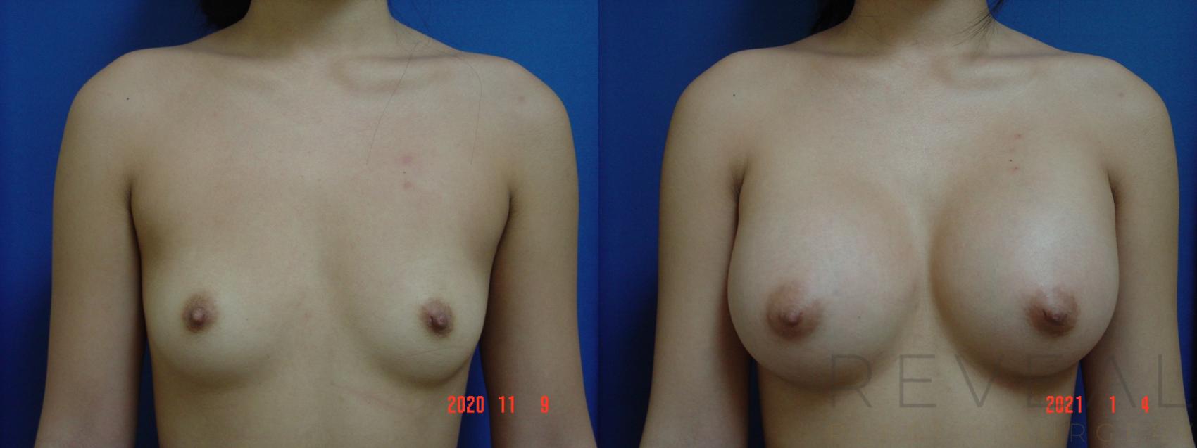 Before & After Breast Augmentation Case 492 View #1 View in San Jose, CA
