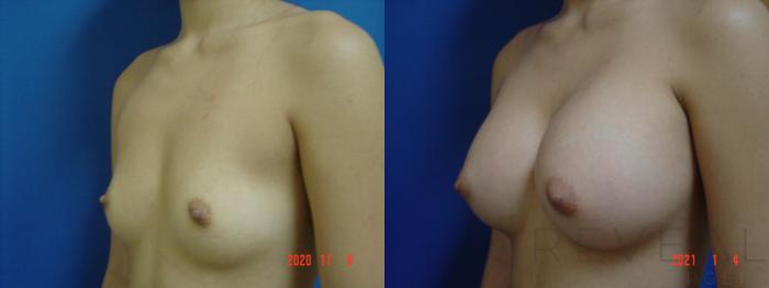 Before & After Breast Augmentation Case 492 View #2 View in San Jose, CA