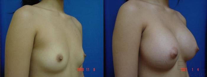 Before & After Breast Augmentation Case 492 View #3 View in San Jose, CA