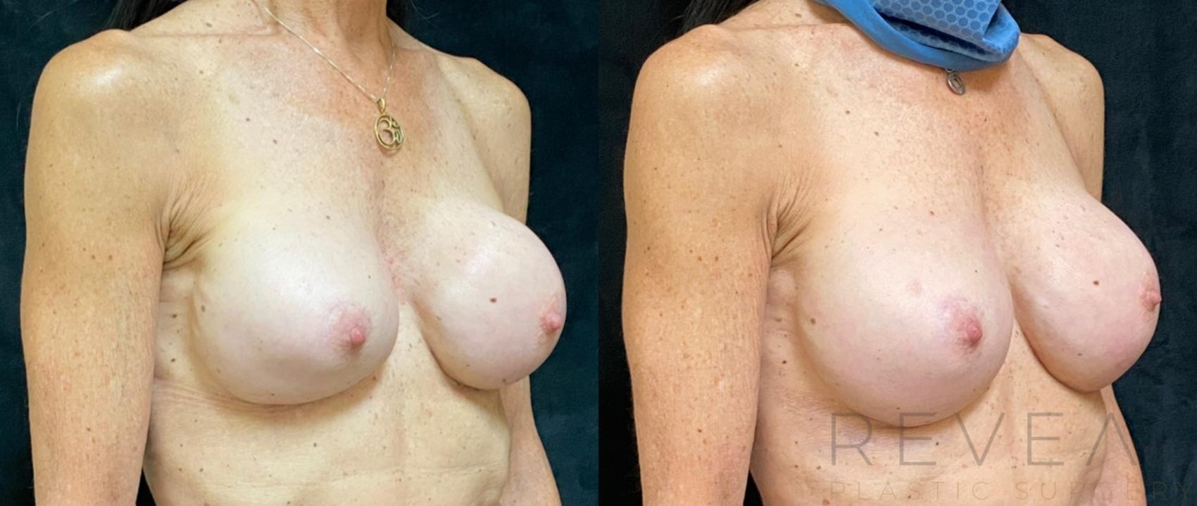 Before & After Breast Augmentation Case 497 View #1 View in San Jose, CA