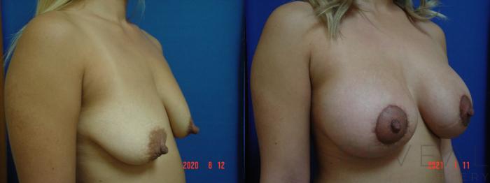 Before & After Breast Lift Case 504 View #2 View in San Jose, CA