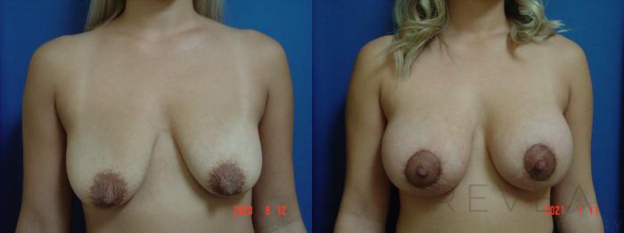 Before & After Breast Lift Case 504 View #3 View in San Jose, CA