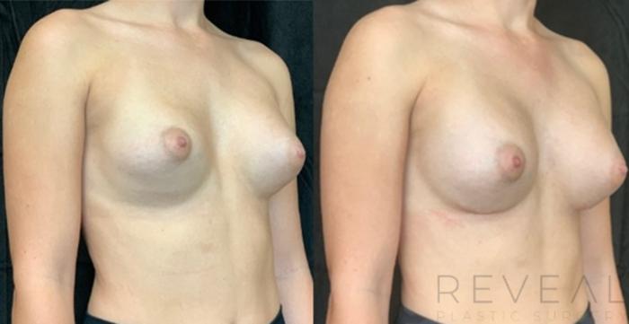 Before & After Breast Augmentation Case 537 View #1 View in San Jose, CA