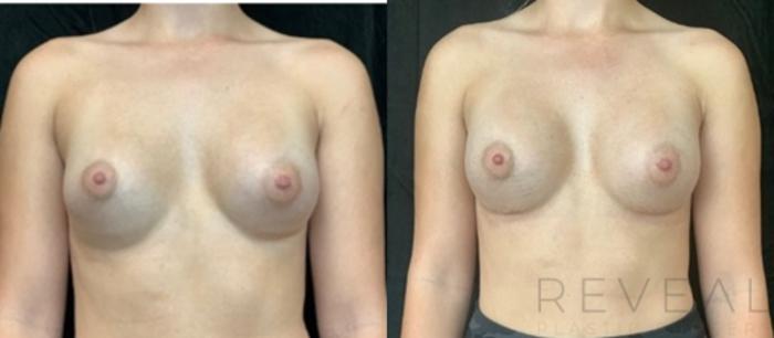 Before & After Breast Augmentation Case 537 View #2 View in San Jose, CA