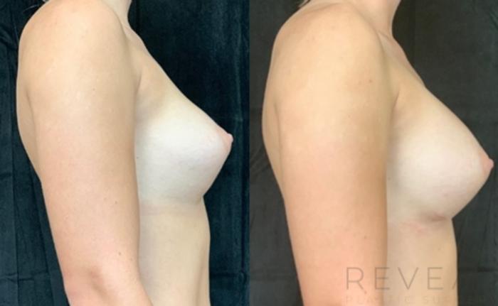 Before & After Breast Augmentation Case 537 View #3 View in San Jose, CA