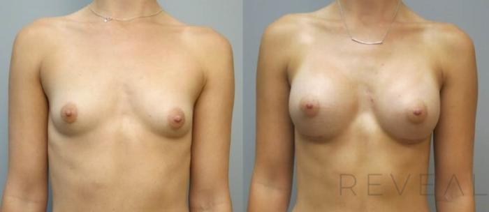 Before & After Breast Augmentation Case 538 View #1 View in San Jose, CA