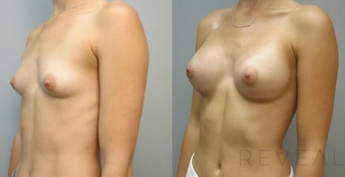 Before & After Breast Augmentation Case 538 View #2 View in San Jose, CA