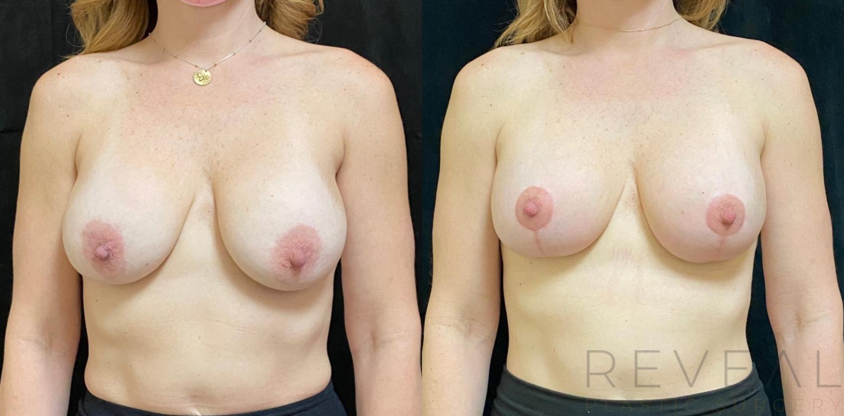 Before & After Breast Lift Case 540 View #1 View in San Jose, CA