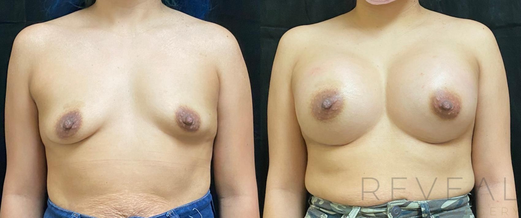 Before & After Breast Augmentation Case 545 View #1 View in San Jose, CA