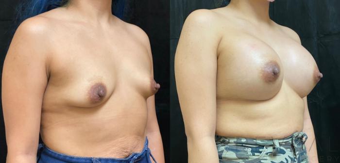 Before & After Breast Augmentation Case 545 View #2 View in San Jose, CA