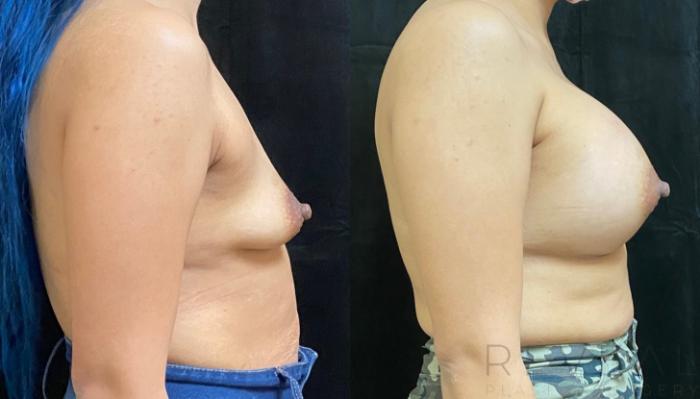 Before & After Breast Augmentation Case 545 View #3 View in San Jose, CA