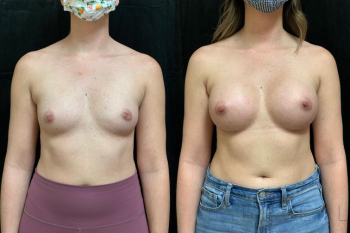 Before & After Breast Augmentation Case 549 View #1 View in San Jose, CA