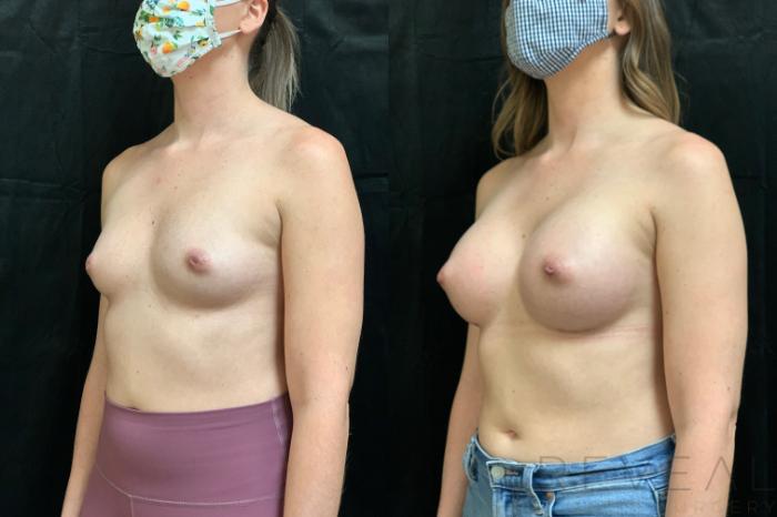 Before & After Breast Augmentation Case 549 View #2 View in San Jose, CA