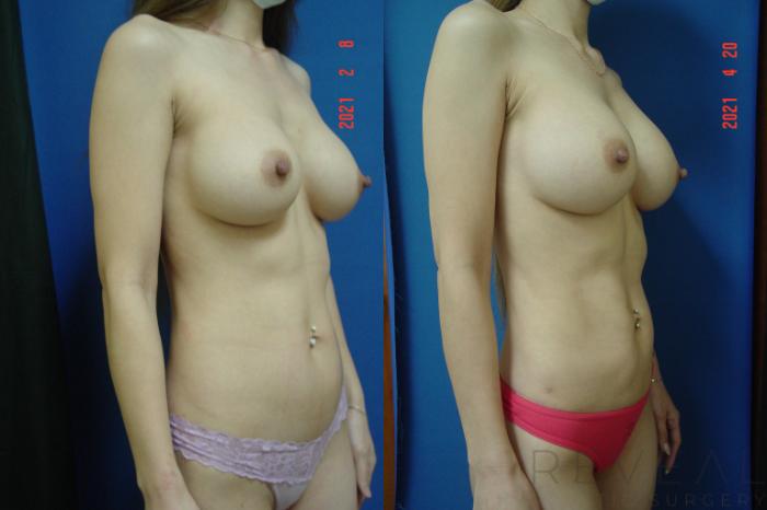 Before & After Liposuction Case 550 View #2 View in San Jose, CA