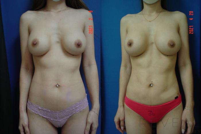 Before & After Breast Augmentation Case 550 View #3 View in San Jose, CA