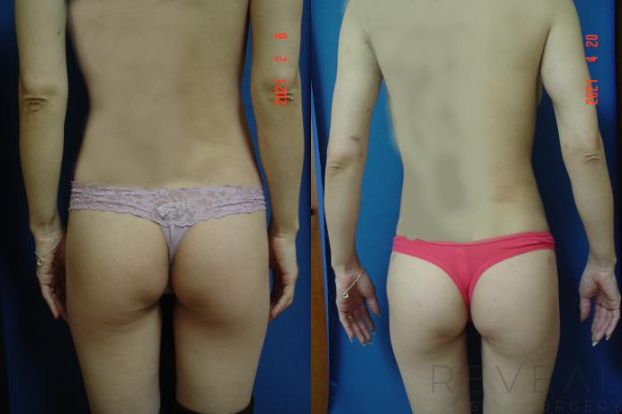 Before & After Brazilian Butt Lift Case 550 View #4 View in San Jose, CA