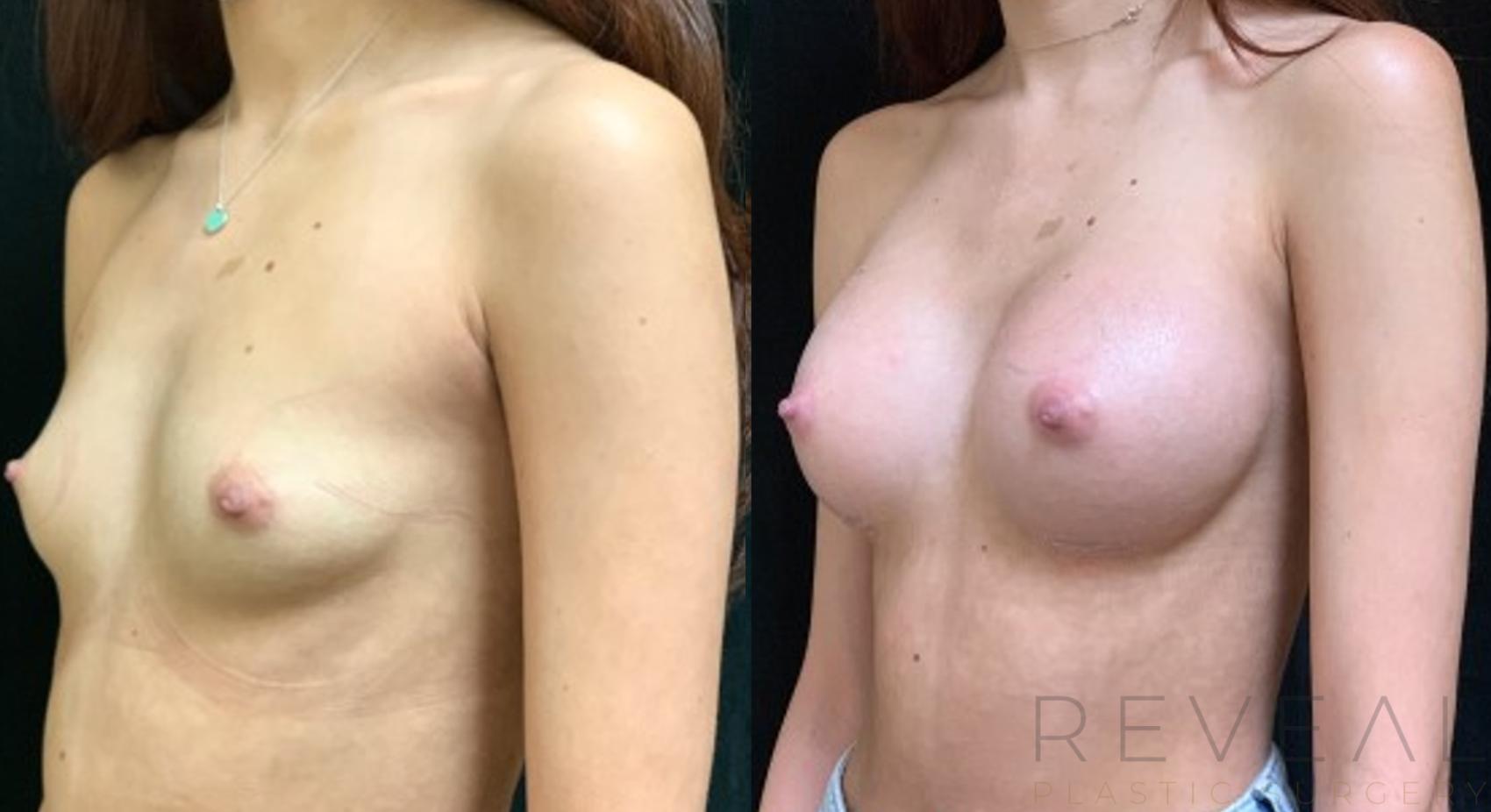 Before & After Breast Augmentation Case 557 View #1 View in San Jose, CA