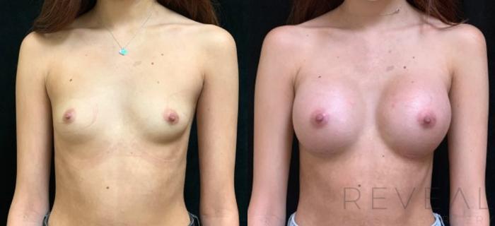 Before & After Breast Augmentation Case 557 View #2 View in San Jose, CA
