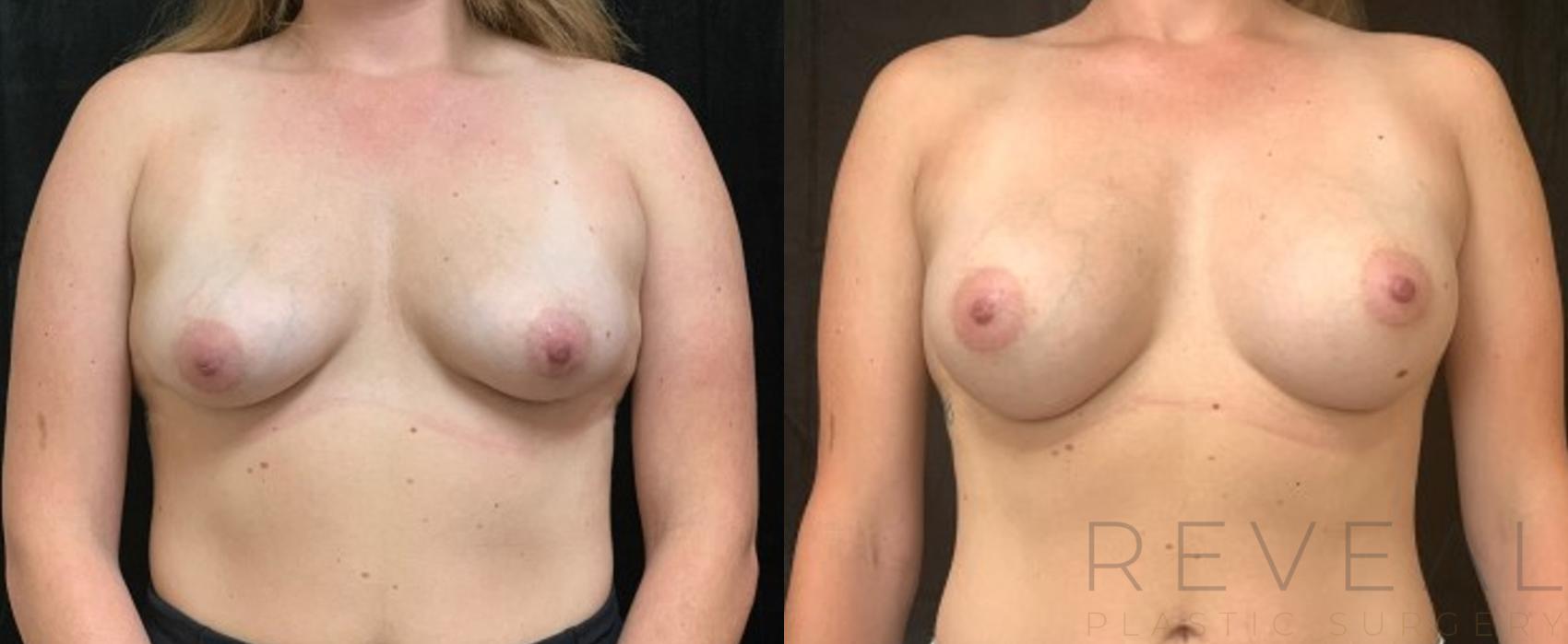 Before & After Breast Augmentation Case 558 View #1 View in San Jose, CA