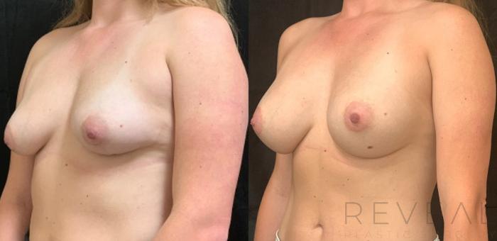 Before & After Breast Augmentation Case 558 View #2 View in San Jose, CA