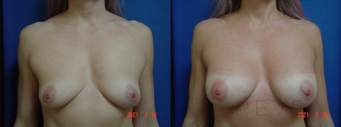 Before & After Breast Augmentation Case 559 View #1 View in San Jose, CA