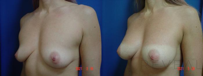 Before & After Breast Augmentation Case 559 View #2 View in San Jose, CA