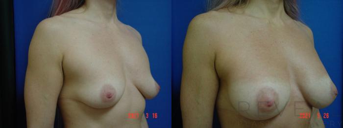 Before & After Breast Augmentation Case 559 View #3 View in San Jose, CA