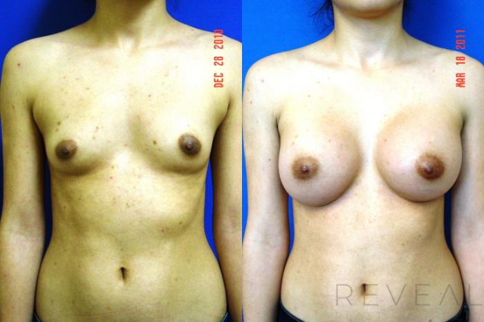 Before & After Breast Augmentation Case 57 View #1 View in San Jose, CA