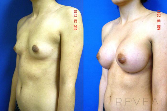 Before & After Breast Augmentation Case 57 View #2 View in San Jose, CA