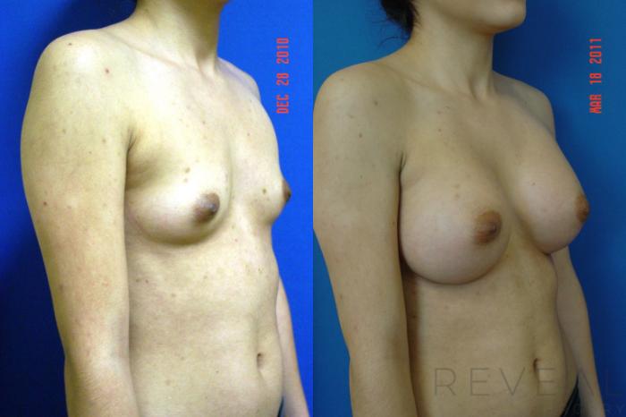 Before & After Breast Augmentation Case 57 View #3 View in San Jose, CA