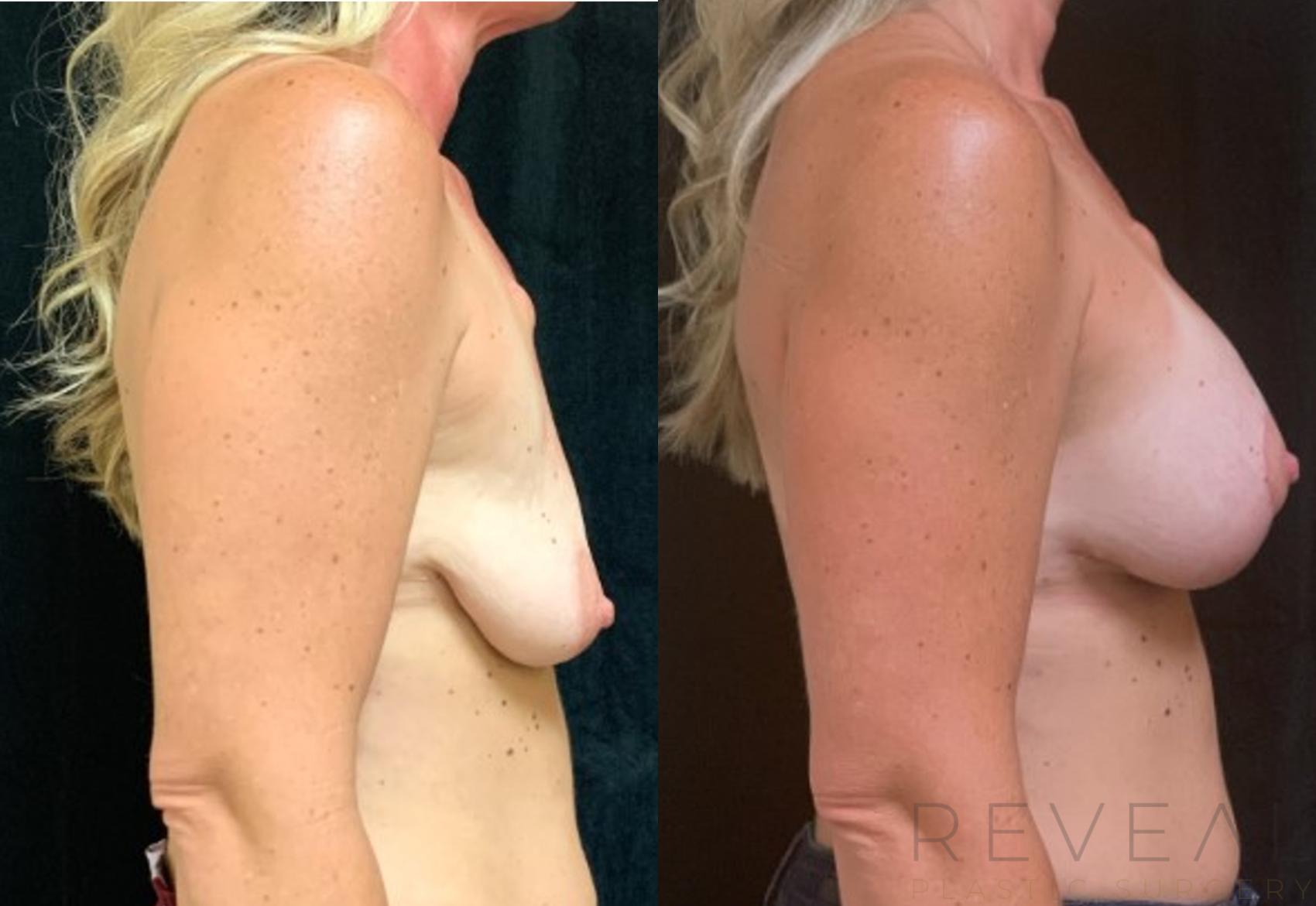 Before & After Breast Augmentation Case 572 View #1 View in San Jose, CA