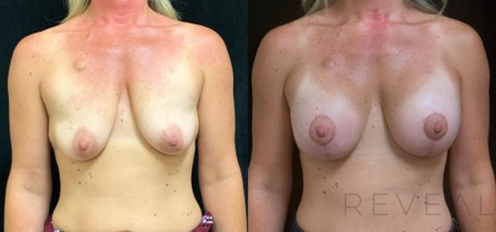 Before & After Breast Augmentation Case 572 View #2 View in San Jose, CA