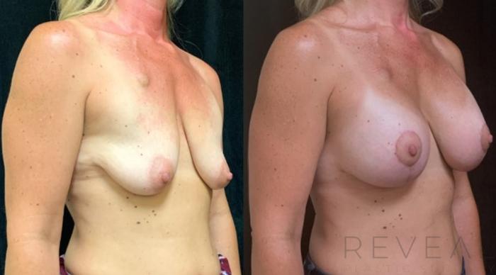 Before & After Breast Augmentation Case 572 View #3 View in San Jose, CA