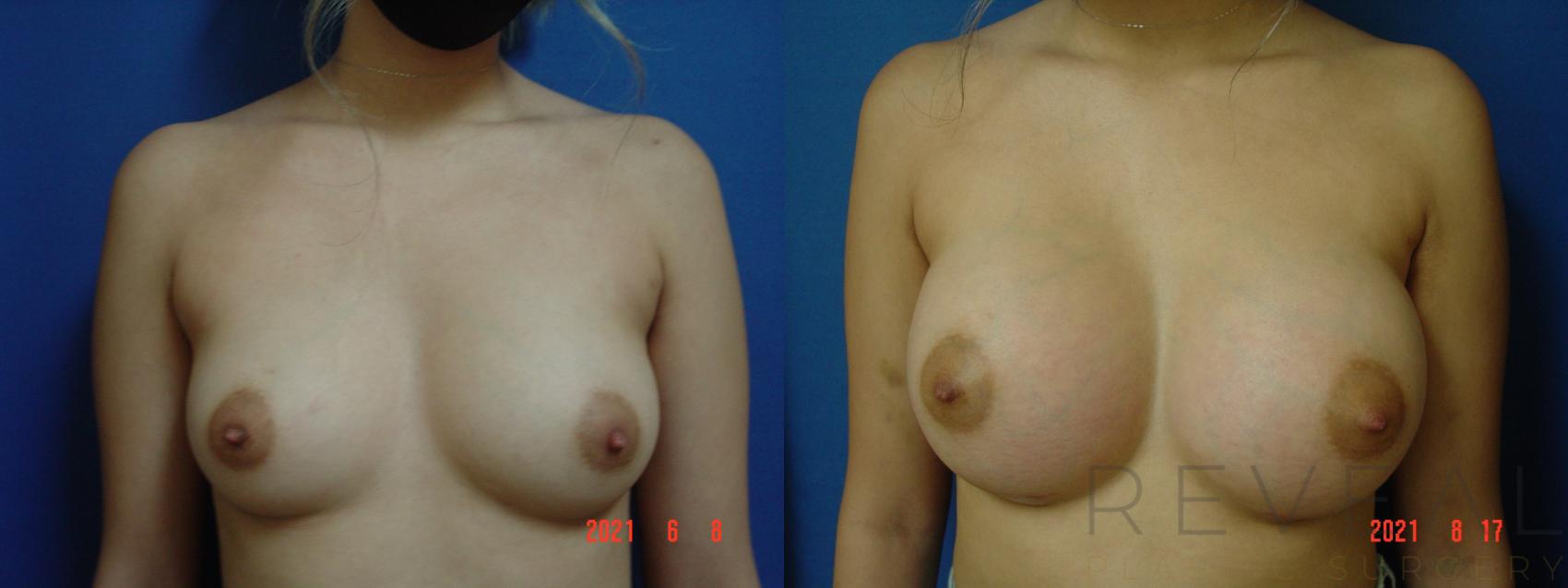 Before & After Breast Augmentation Case 574 View #1 View in San Jose, CA