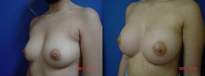 Before & After Breast Augmentation Case 574 View #2 View in San Jose, CA