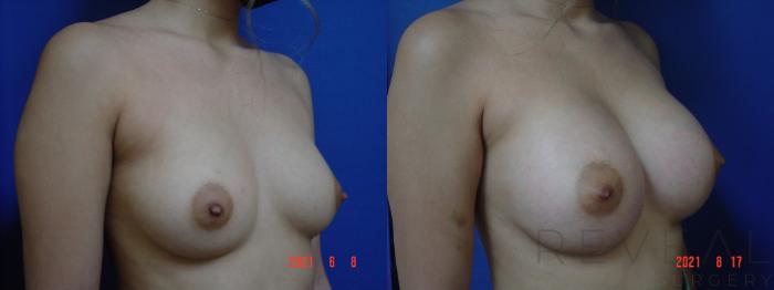 Before & After Breast Augmentation Case 574 View #3 View in San Jose, CA