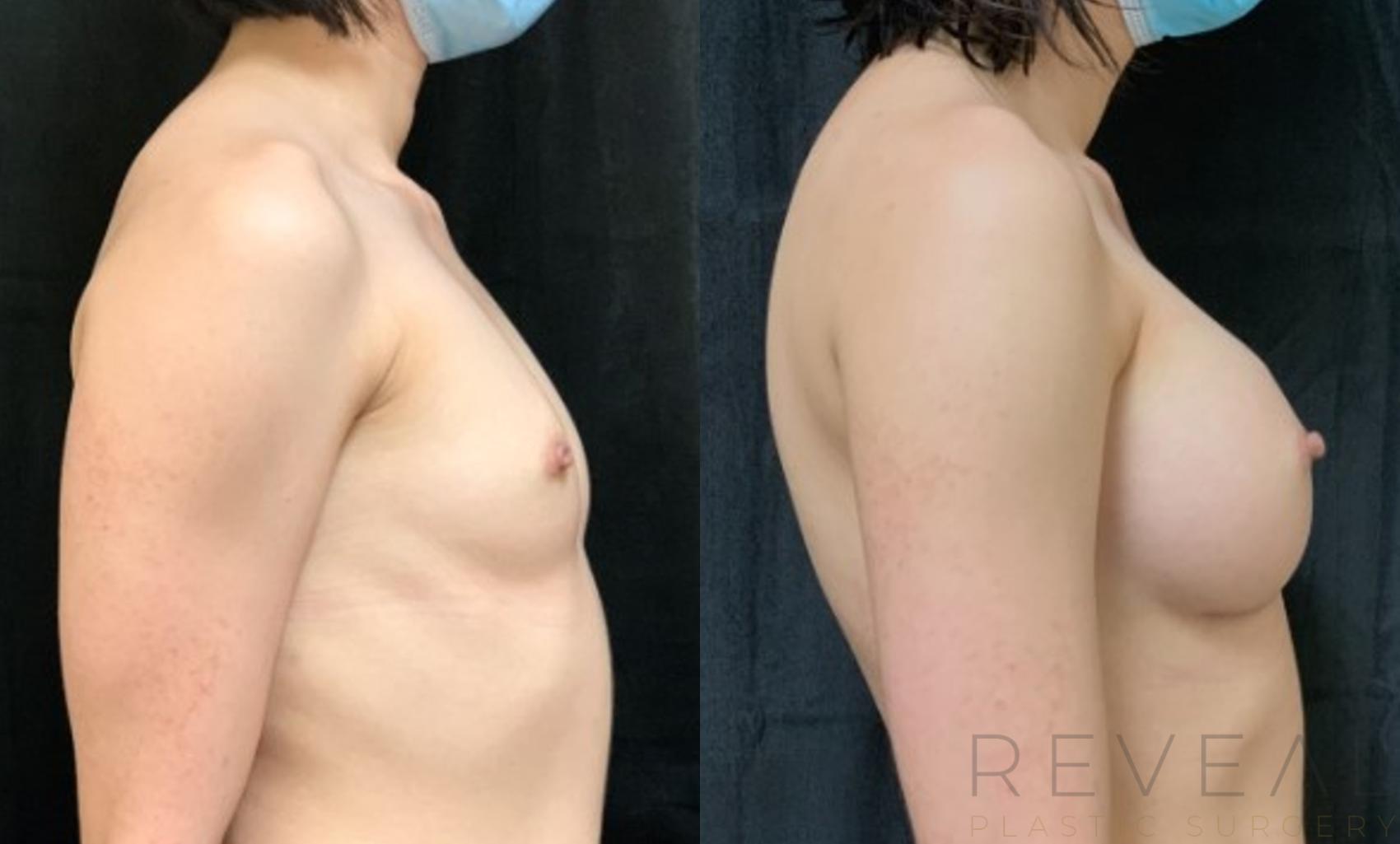 Before & After Breast Augmentation Case 576 View #1 View in San Jose, CA