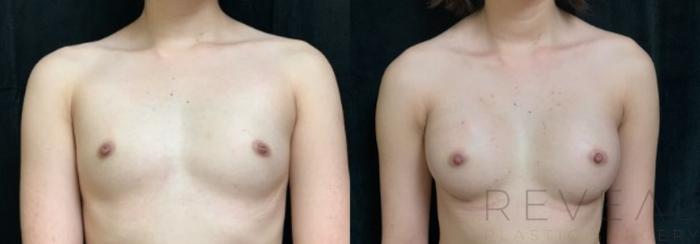 Before & After Breast Augmentation Case 576 View #2 View in San Jose, CA