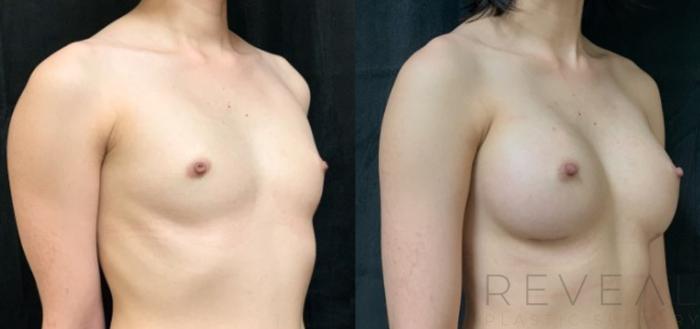 Before & After Breast Augmentation Case 576 View #3 View in San Jose, CA