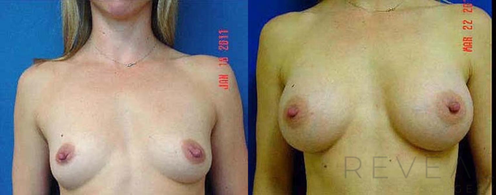 Before & After Breast Augmentation Case 58 View #1 View in San Jose, CA