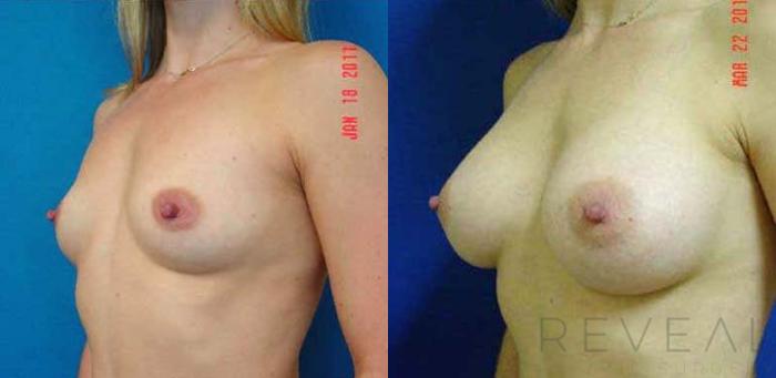 Before & After Breast Augmentation Case 58 View #2 View in San Jose, CA