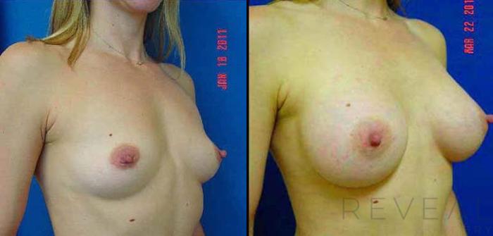 Before & After Breast Augmentation Case 58 View #3 View in San Jose, CA