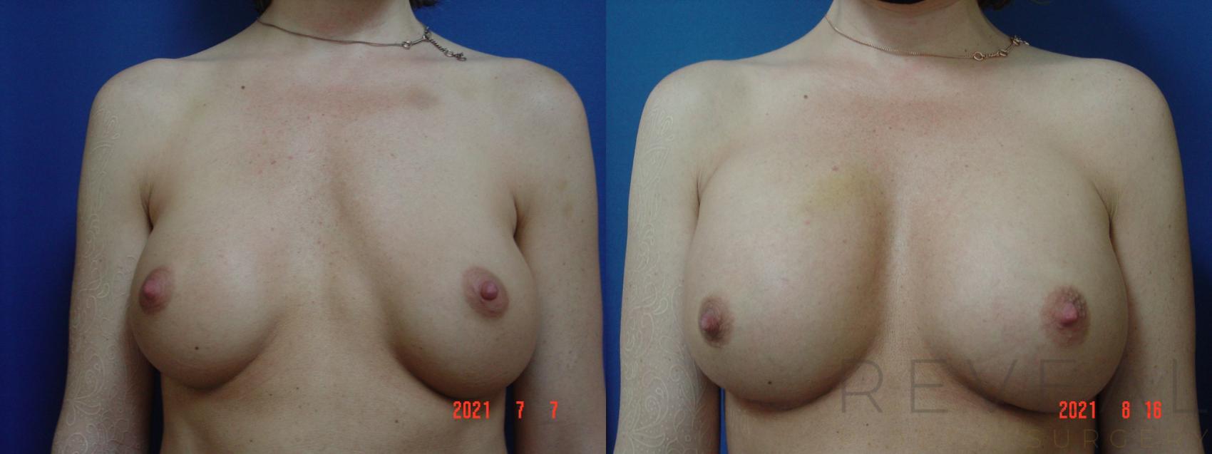 Before & After Breast Augmentation Case 581 View #1 View in San Jose, CA