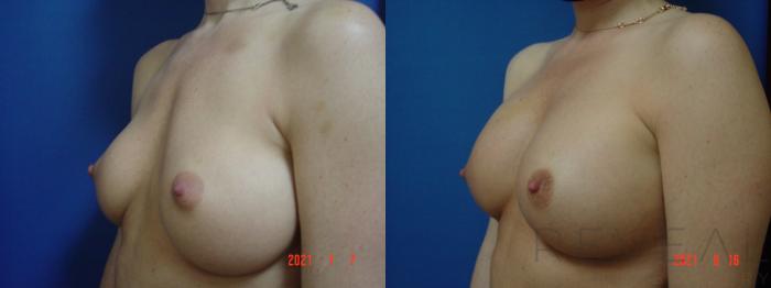 Before & After Breast Augmentation Case 581 View #2 View in San Jose, CA