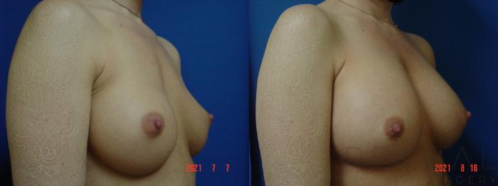 Before & After Breast Augmentation Case 581 View #3 View in San Jose, CA